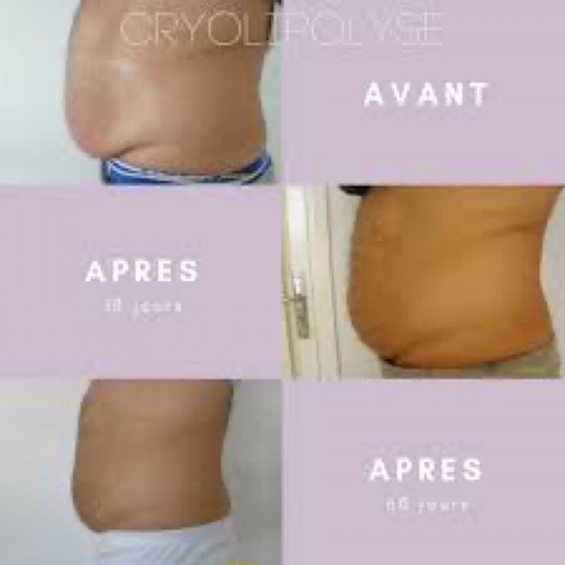 Ou trouver institut pour séance de cryolipolyse à avignon 84000